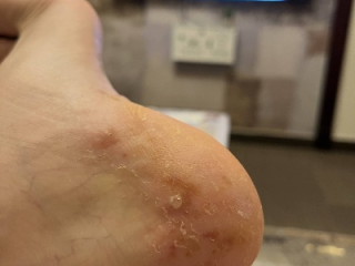 脚上起小水泡还很痒？别忽视，这几种常见原因在作怪
